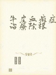 牛皮血癣症怎么治疗除根