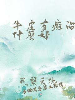 牛皮有癣治疗用什么好