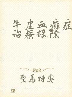 牛皮血癣症怎么治疗根除