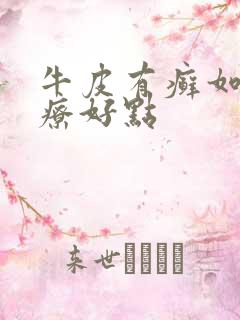 牛皮有癣如何治疗好点