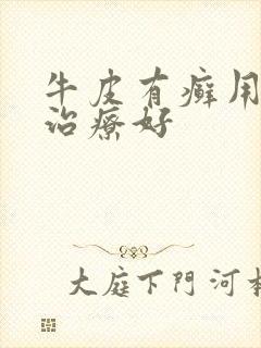 牛皮有癣用什么治疗好