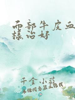 面部牛皮血癣怎样治好