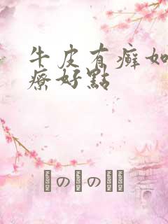 牛皮有癣如何治疗好点