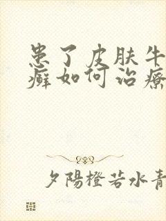 患了皮肤牛皮有癣如何治疗