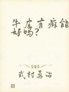 牛皮有癣能治疗好吗?