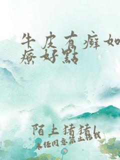 牛皮有癣如何治疗好点