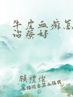 牛皮血癣怎么能治疗好