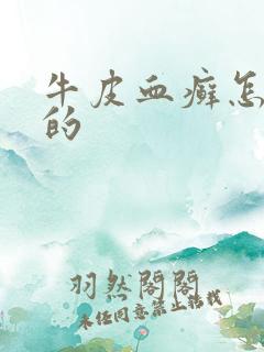 牛皮血癣怎么得的