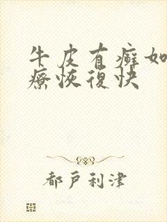 牛皮有癣如何治疗恢复快