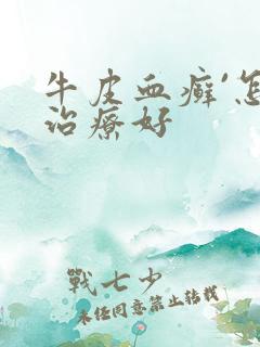 牛皮血癣`怎么治疗好