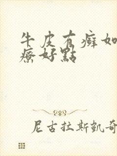 牛皮有癣如何治疗好点