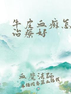 牛皮血癣怎么能治疗好