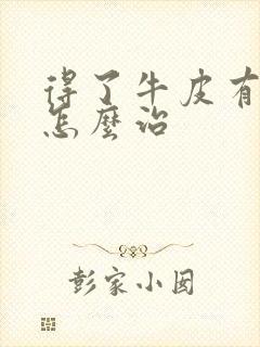 得了牛皮有癣该怎么治