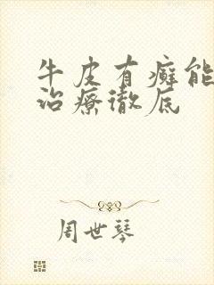 牛皮有癣能怎么治疗彻底