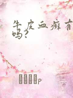 牛皮血癣有得治吗?