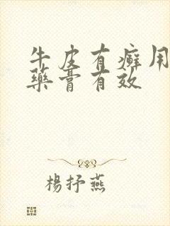 牛皮有癣用什么药膏有效