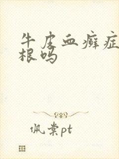 牛皮血癣症能除根吗