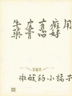 牛皮有癣用什么药膏治好