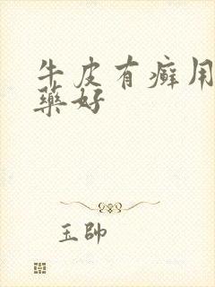 牛皮有癣用什么药好