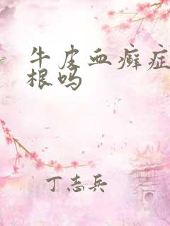 牛皮血癣症能除根吗