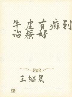 牛皮有癣到哪里治疗好