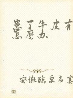 患了牛皮有癣该怎么办