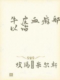 牛皮血癣哪里可以治