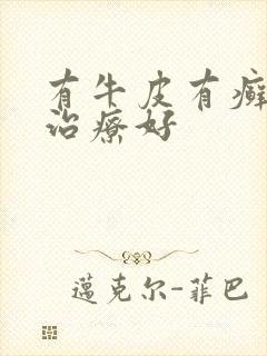 有牛皮有癣怎么治疗好