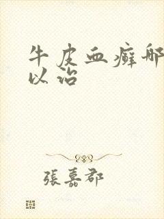 牛皮血癣哪里可以治