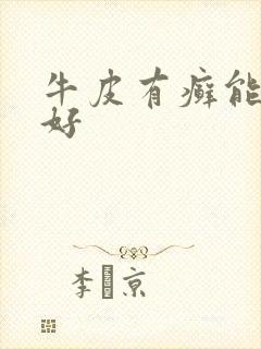 牛皮有癣能治疗好