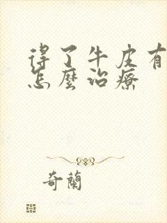 得了牛皮有癣该怎么治疗