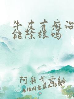 牛皮有癣治疗皮能除根吗