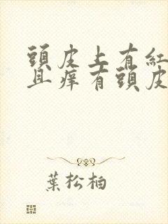 头皮上有红斑而且痒有头皮屑