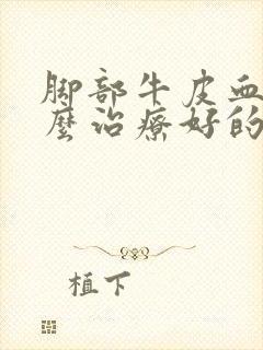 脚部牛皮血癣怎么治疗好的快