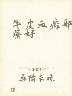 牛皮血癣哪里治疗好