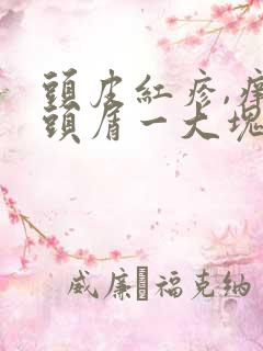 头皮红疹,痒,头屑一大块怎么办