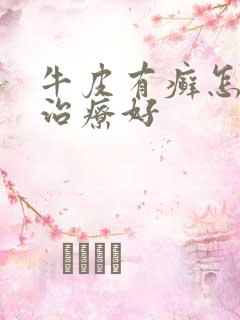 牛皮有癣怎么样治疗好