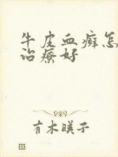 牛皮血癣怎么能治疗好