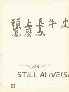 头上长牛皮有癣怎么办