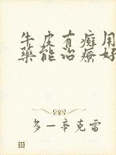 牛皮有癣用什么药能治疗好