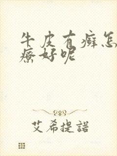 牛皮有癣怎么治疗好呢