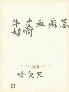 牛皮血癣怎么治好啊