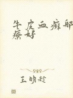 牛皮血癣哪里治疗好