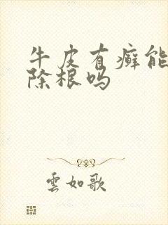 牛皮有癣能治好除根吗