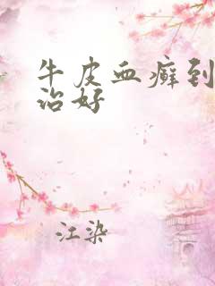 牛皮血癣到哪里治好