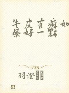 牛皮有癣如何治疗好一点