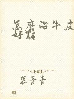 怎么治牛皮有癣好点