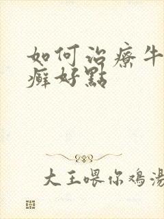 如何治疗牛皮有癣好点