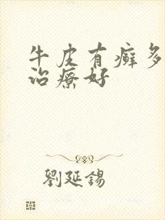 牛皮有癣多久能治疗好