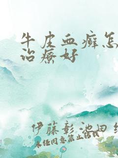 牛皮血癣怎么能治疗好